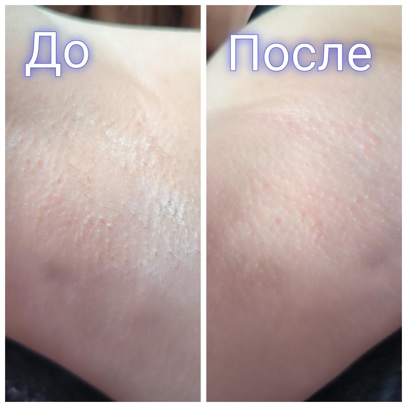 Шугаринг