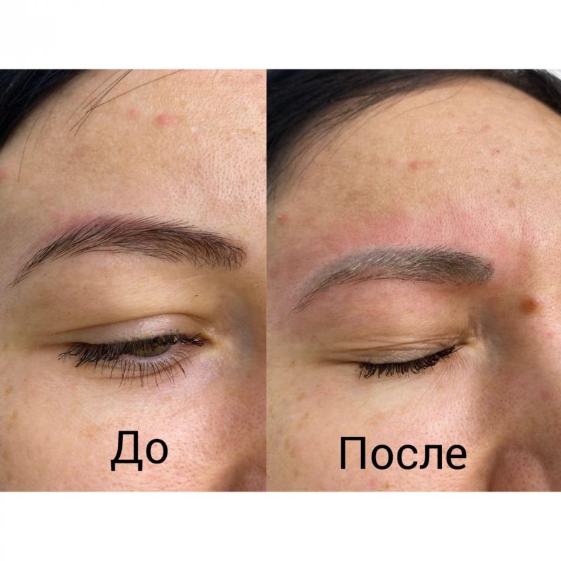 Удаление лазером тату и татуаж, карбоновый пилинг